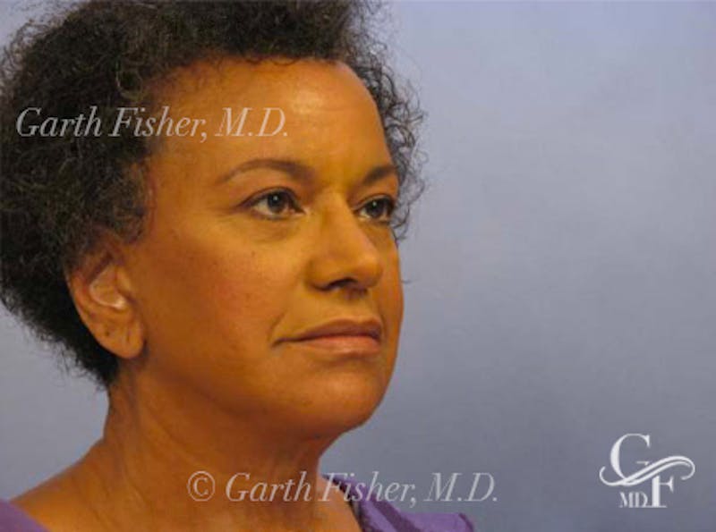 Facelift Before & After Gallery - Patient 461832 - Image 4