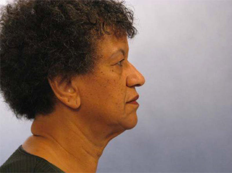 Facelift Before & After Gallery - Patient 461832 - Image 5