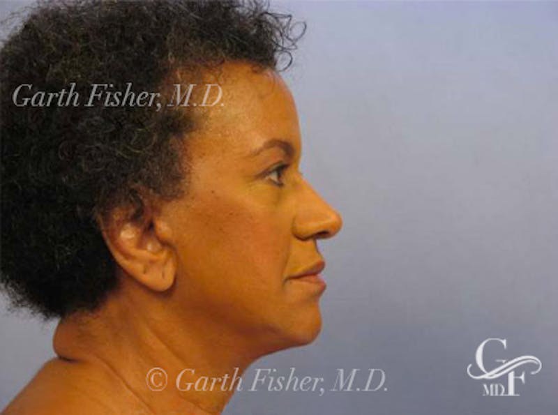 Facelift Before & After Gallery - Patient 461832 - Image 6
