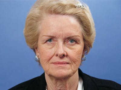 Facelift Before & After Gallery - Patient 298445 - Image 1