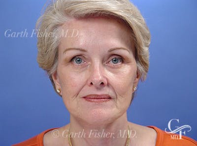 Facelift Before & After Gallery - Patient 298445 - Image 2