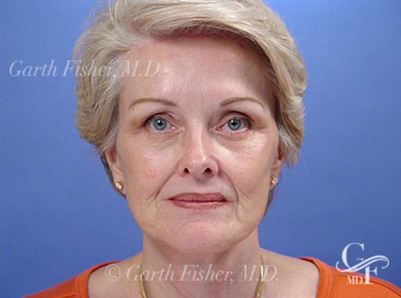 Facelift Before & After Gallery - Patient 298445 - Image 2