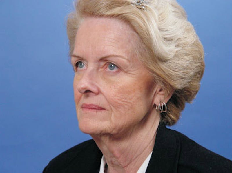 Facelift Before & After Gallery - Patient 298445 - Image 3
