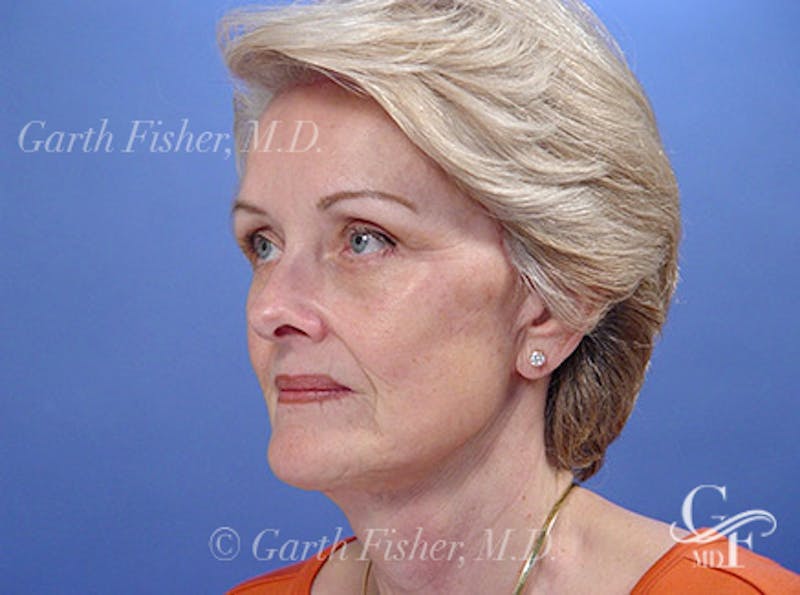 Facelift Before & After Gallery - Patient 298445 - Image 4