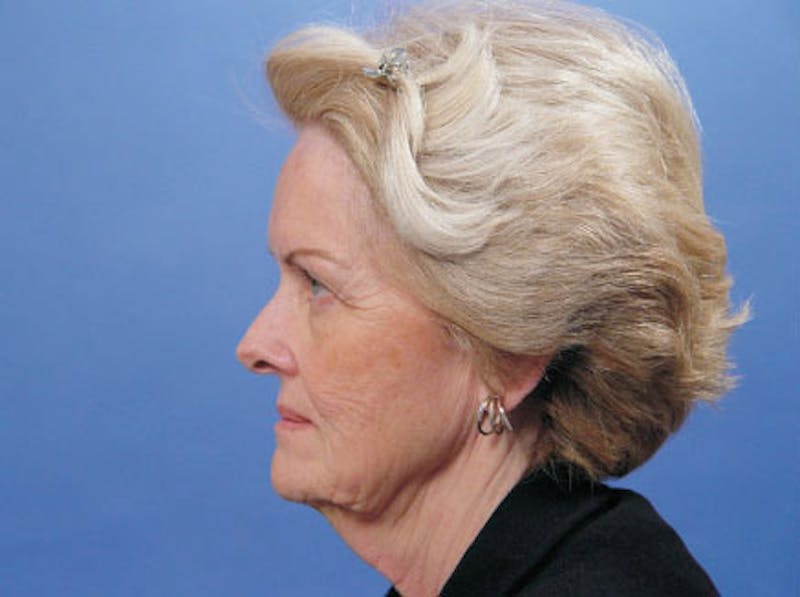 Facelift Before & After Gallery - Patient 298445 - Image 5