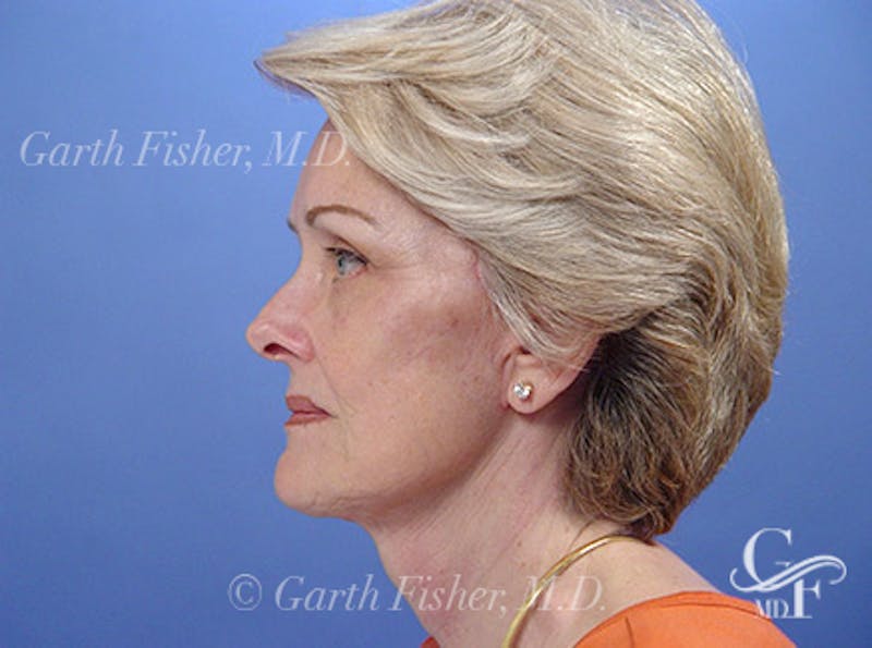 Facelift Before & After Gallery - Patient 298445 - Image 6