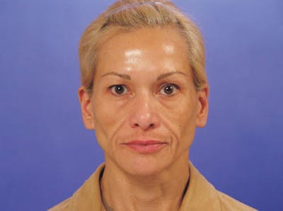 Facelift Before & After Gallery - Patient 428413 - Image 1