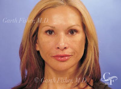 Facelift Before & After Gallery - Patient 428413 - Image 2