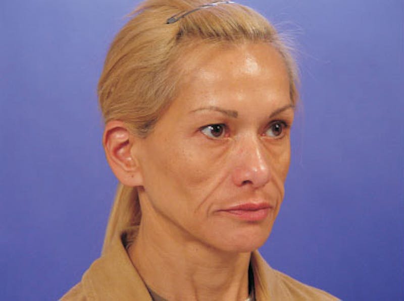 Facelift Before & After Gallery - Patient 428413 - Image 3