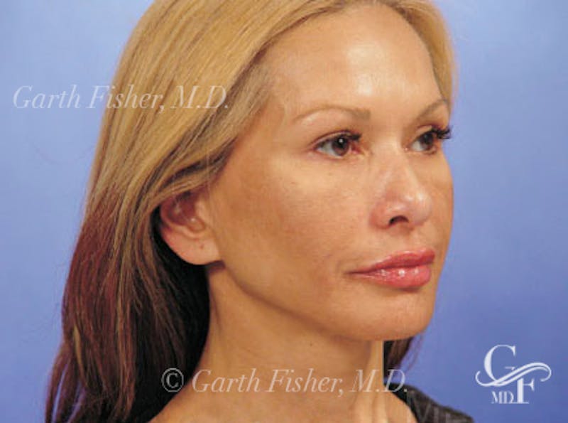 Facelift Before & After Gallery - Patient 428413 - Image 4