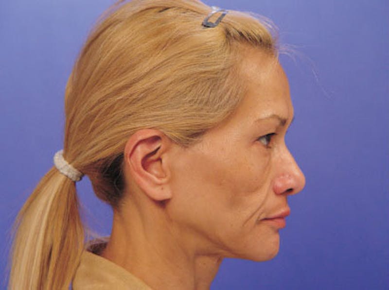 Facelift Before & After Gallery - Patient 428413 - Image 5