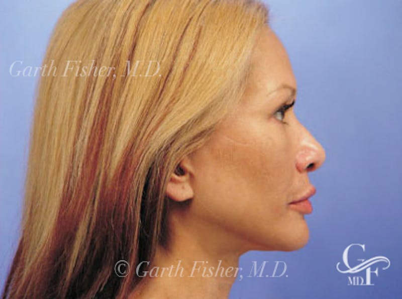 Facelift Before & After Gallery - Patient 428413 - Image 6