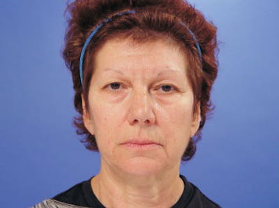 Facelift Before & After Gallery - Patient 402136 - Image 1