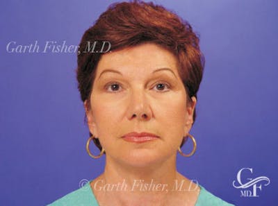 Facelift Before & After Gallery - Patient 402136 - Image 2