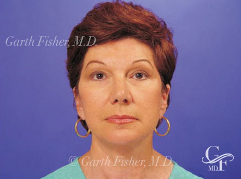 Facelift Before & After Gallery - Patient 402136 - Image 2