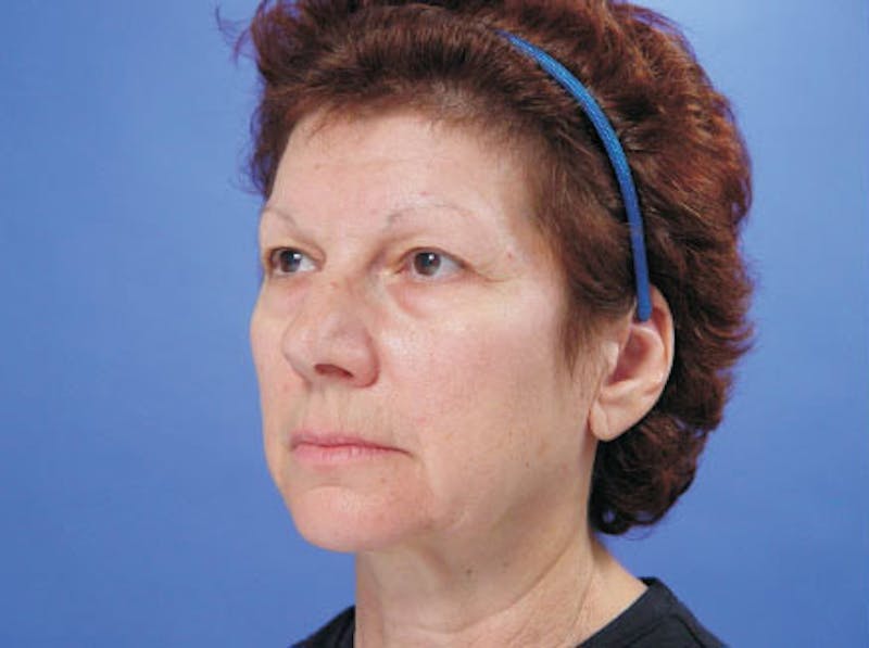 Facelift Before & After Gallery - Patient 402136 - Image 3
