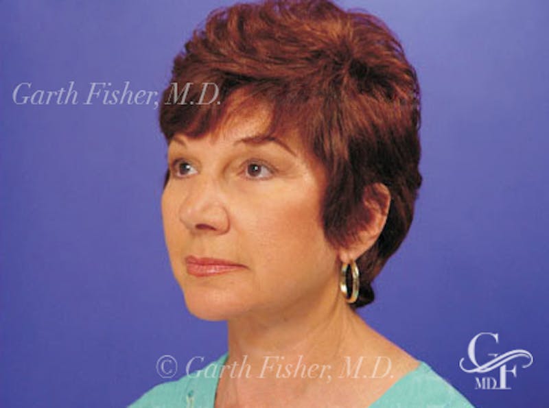 Facelift Before & After Gallery - Patient 402136 - Image 4