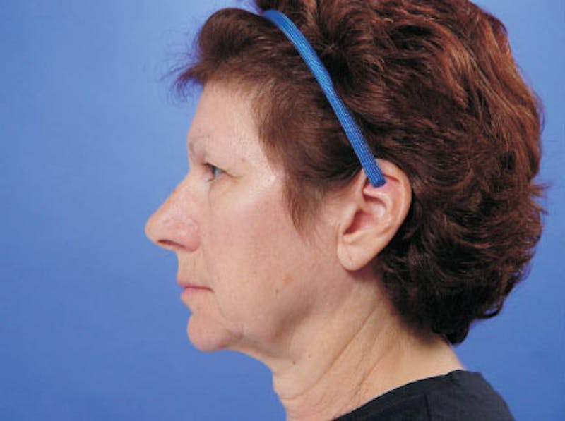 Facelift Before & After Gallery - Patient 402136 - Image 5
