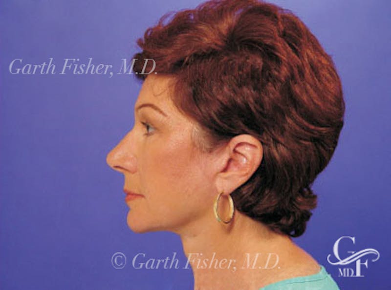 Facelift Before & After Gallery - Patient 402136 - Image 6