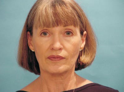 Facelift Before & After Gallery - Patient 220087 - Image 1
