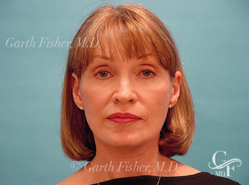 Facelift Before & After Gallery - Patient 220087 - Image 2