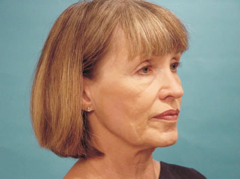 Facelift Before & After Gallery - Patient 220087 - Image 3