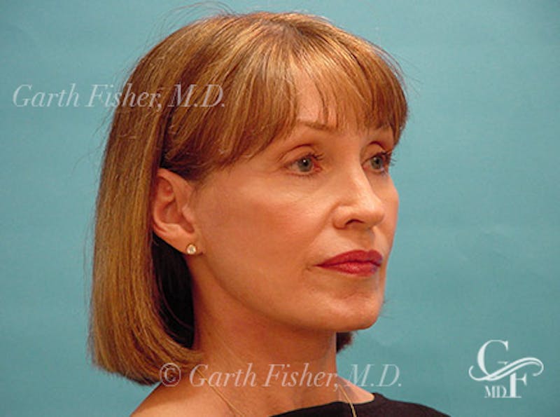 Facelift Before & After Gallery - Patient 220087 - Image 4