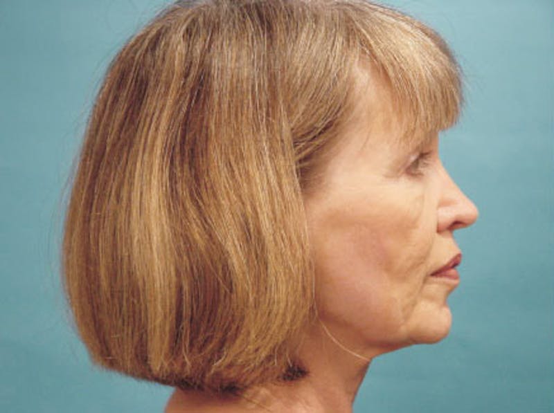 Facelift Before & After Gallery - Patient 220087 - Image 5