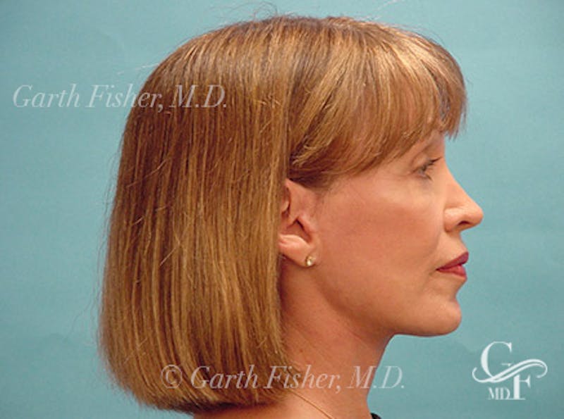 Facelift Before & After Gallery - Patient 220087 - Image 6
