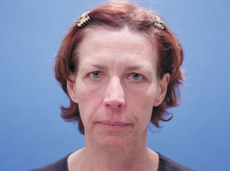 Facelift Before & After Gallery - Patient 244873 - Image 1