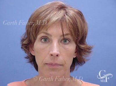 Facelift Before & After Gallery - Patient 244873 - Image 2