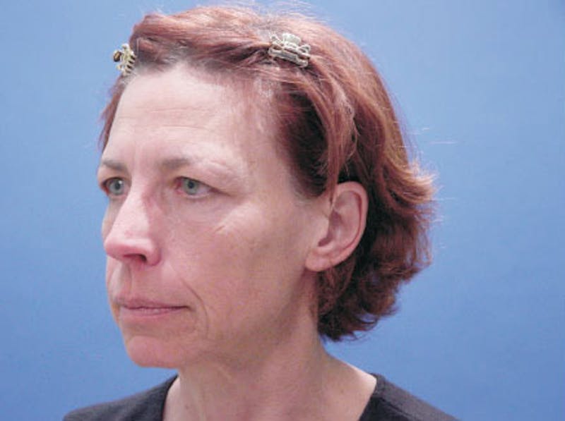 Facelift Before & After Gallery - Patient 244873 - Image 3