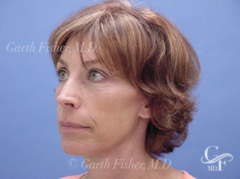 Facelift Before & After Gallery - Patient 244873 - Image 4