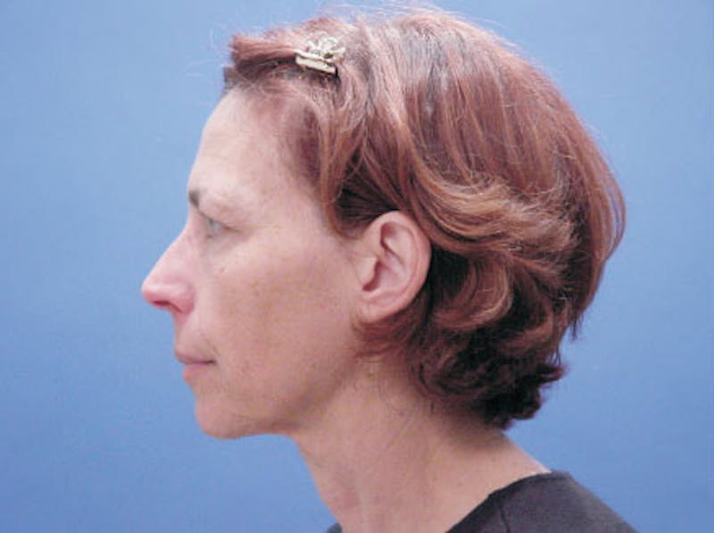 Facelift Before & After Gallery - Patient 244873 - Image 5
