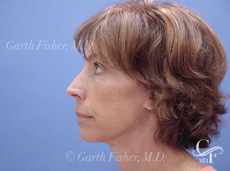 Facelift Before & After Gallery - Patient 244873 - Image 6