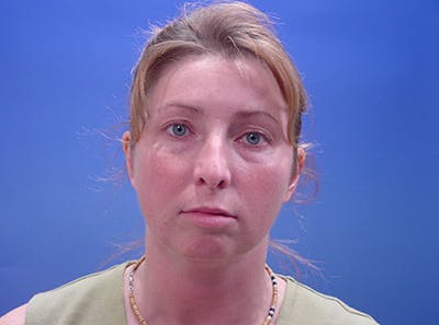 Facelift Before & After Gallery - Patient 188066 - Image 1