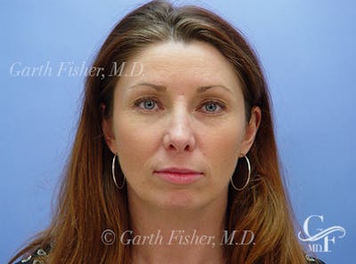 Facelift Before & After Gallery - Patient 188066 - Image 2
