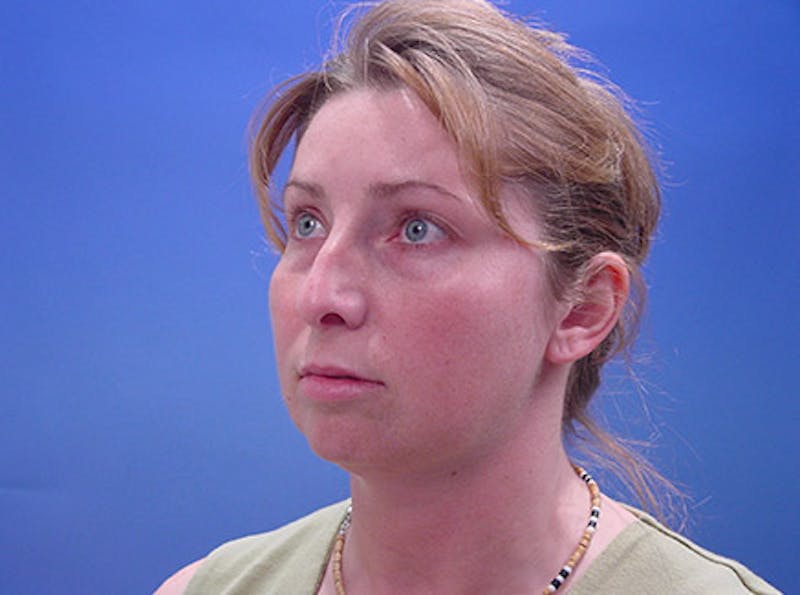 Facelift Before & After Gallery - Patient 188066 - Image 3