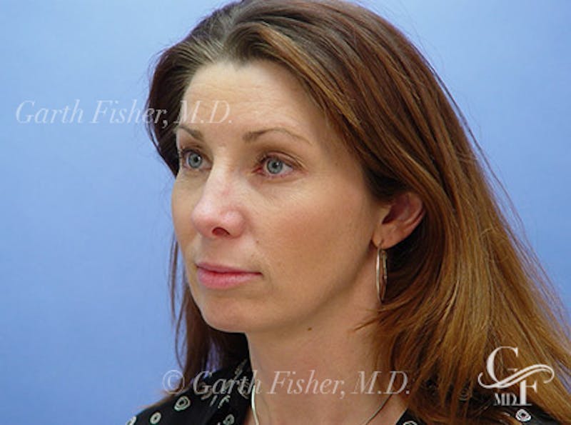 Facelift Before & After Gallery - Patient 188066 - Image 4