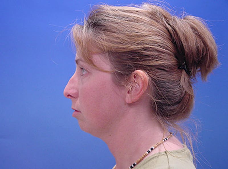 Facelift Before & After Gallery - Patient 188066 - Image 5