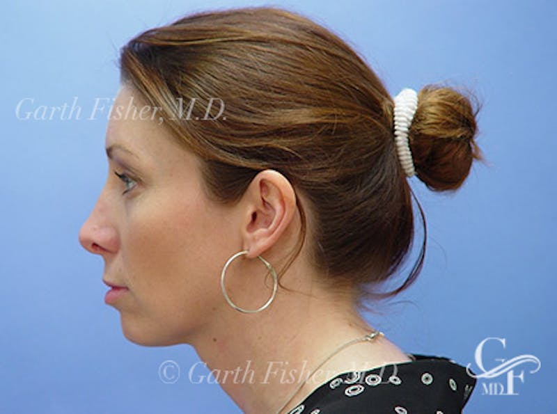 Facelift Before & After Gallery - Patient 188066 - Image 6