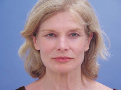 Facelift Before & After Gallery - Patient 157128 - Image 1