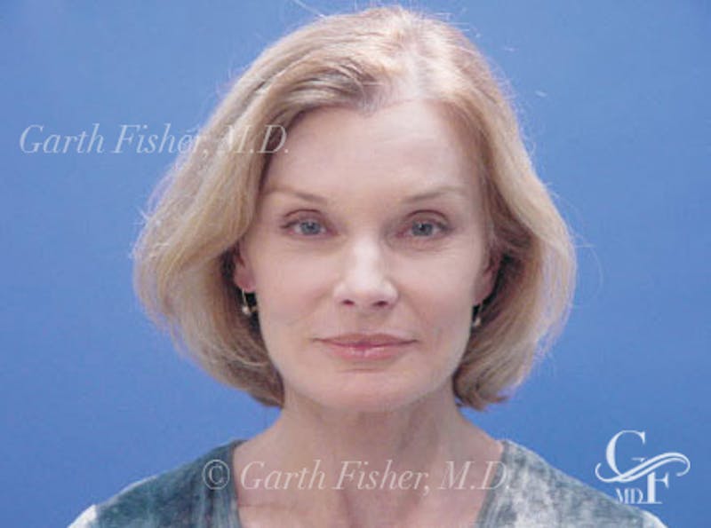 Facelift Before & After Gallery - Patient 157128 - Image 2