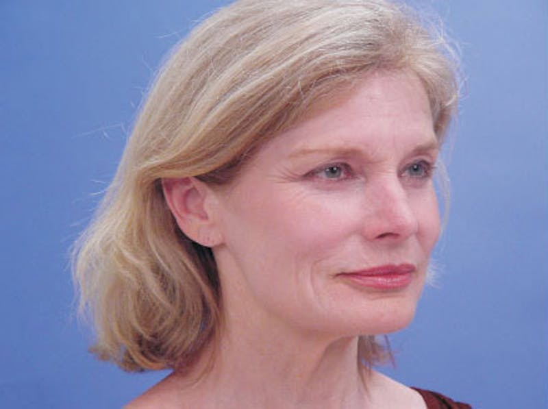 Facelift Before & After Gallery - Patient 157128 - Image 3