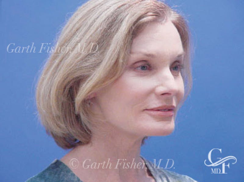 Facelift Before & After Gallery - Patient 157128 - Image 4