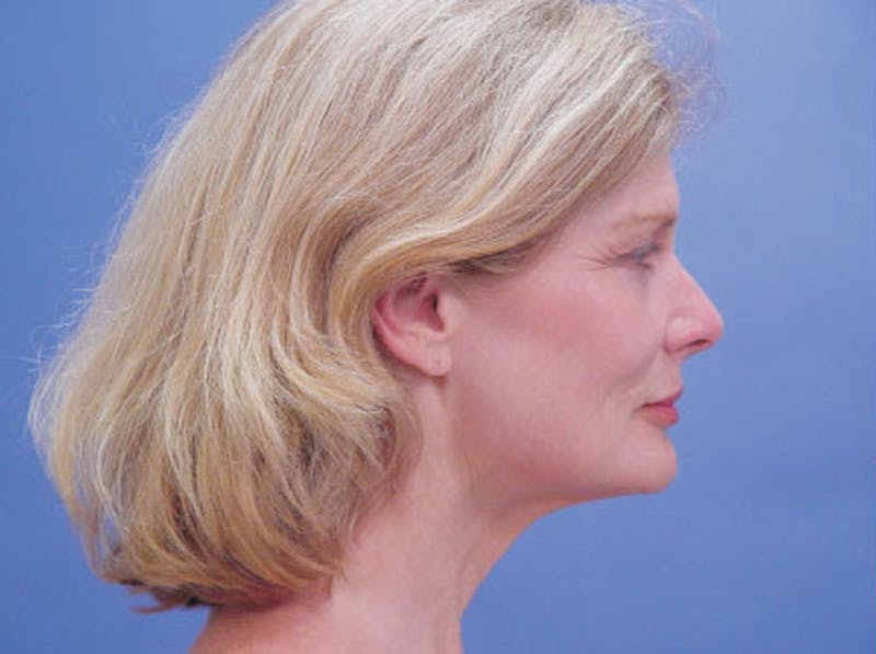 Facelift Before & After Gallery - Patient 157128 - Image 5