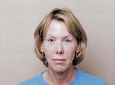 Facelift Before & After Gallery - Patient 380850 - Image 1
