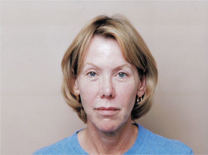 Facelift Before & After Gallery - Patient 380850 - Image 1