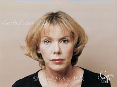 Facelift Before & After Gallery - Patient 380850 - Image 2