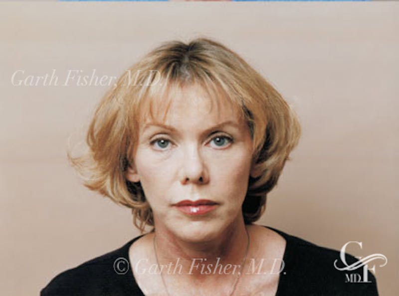 Facelift Before & After Gallery - Patient 380850 - Image 2